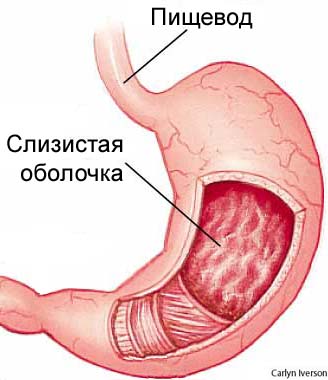 гастрит гастрит